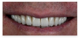 Closeup of dental patient after dental crowns