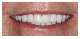 Full face of dental patient after dental crowns