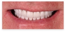 Closeup of dental patient after full mouth rehabilitation
