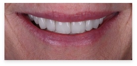 Closeup of dental patient after smile makeover