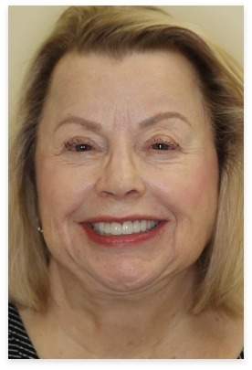 Full face of dental patient after smile makeover