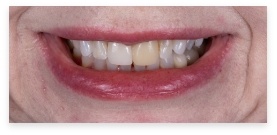 Closeup of dental patient before smile makeover
