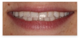 Closeup of dental patient before smile makeover