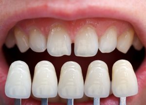 Porcelain veneers compared to imperfect teeth.